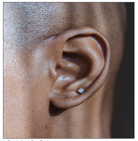 Ear infections can occur from a variety of activities, including swimming
